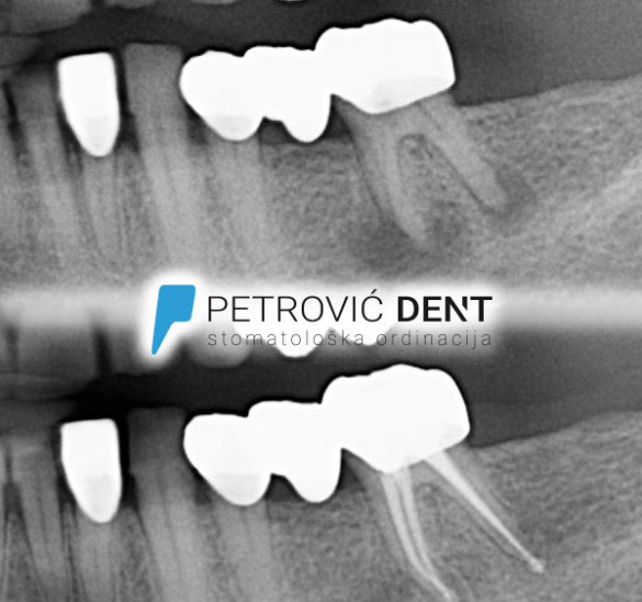 Endodontski tretman