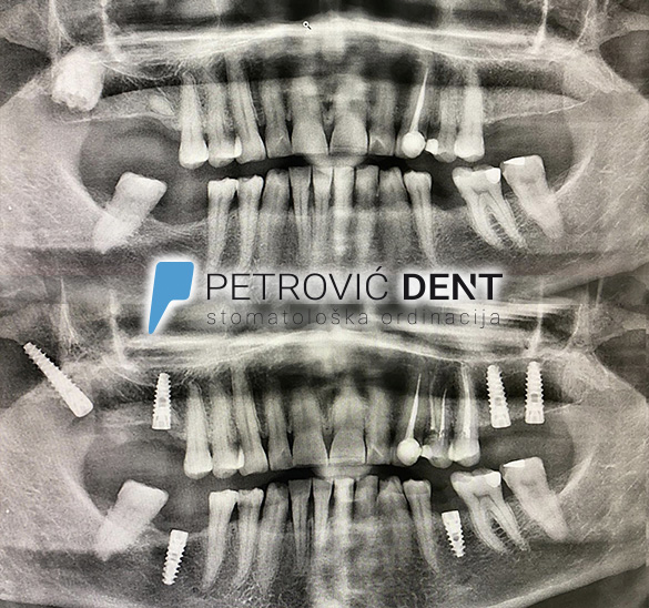 Wisdom tooth extraction and implant